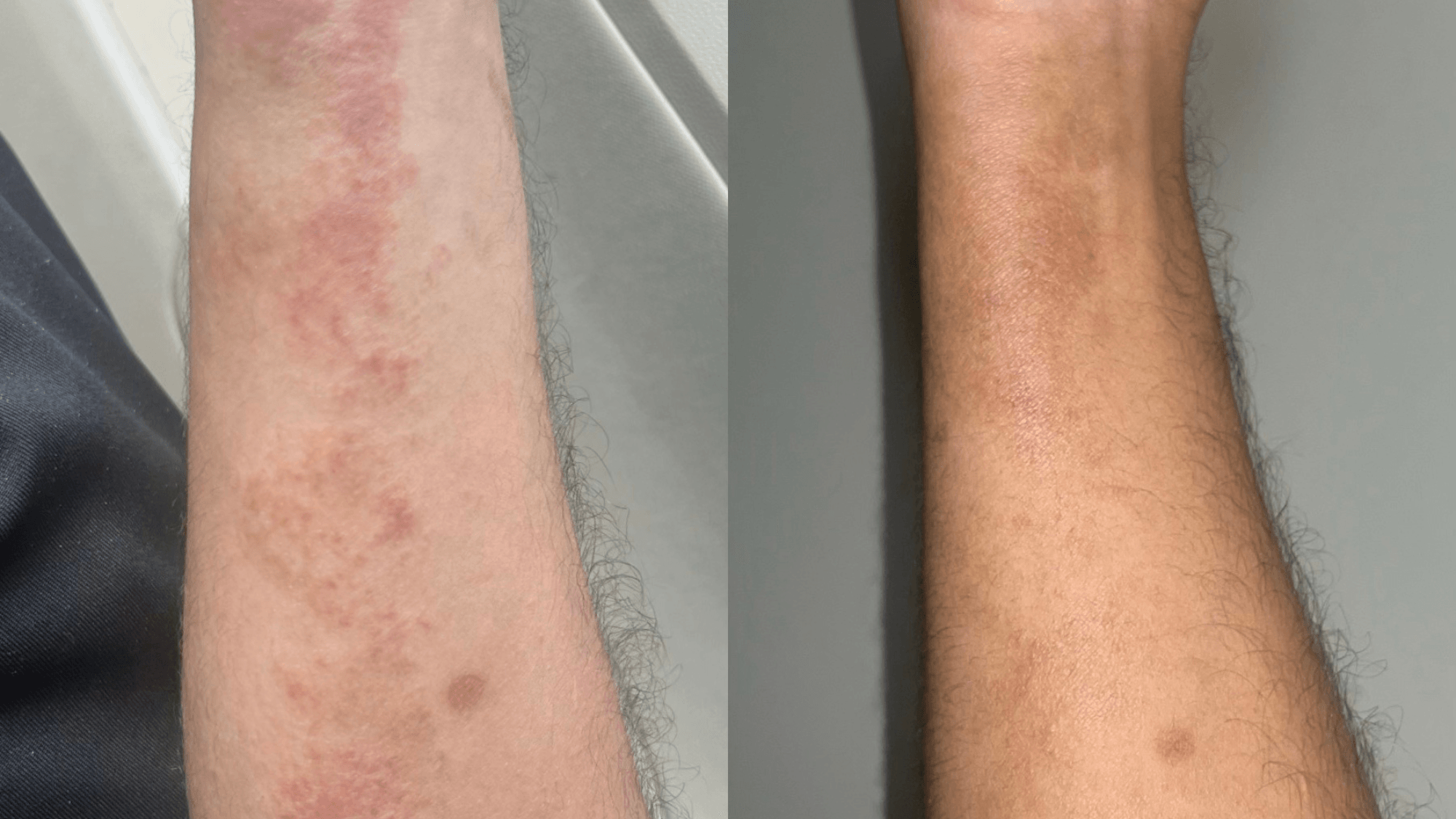 Before and after comparison of a man's arm using Blakely Bath & Co products, showing dry, rough skin transformed into smooth, hydrated, and healthy-looking skin