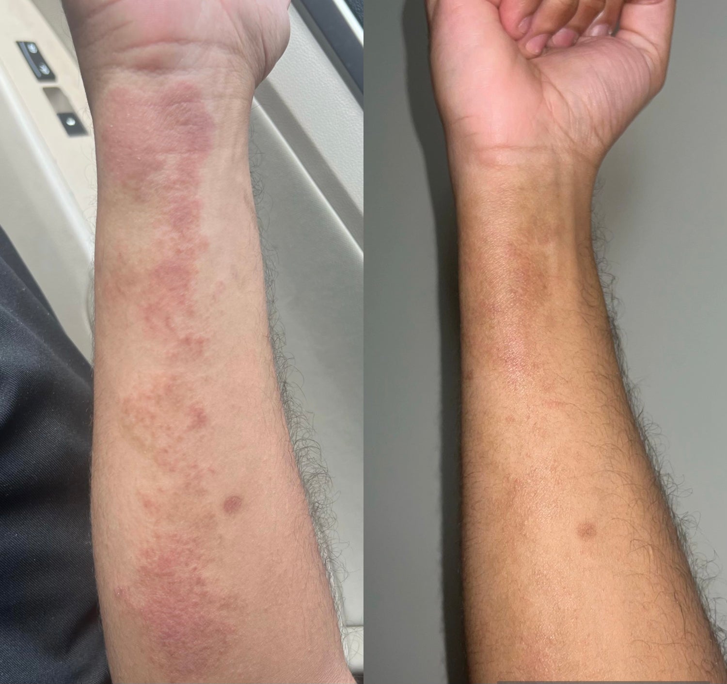 Before and after customer testimonial with our eczema kit also known as all-in-one skincare duo - Blakely Bath & Co - blakelybathco.com