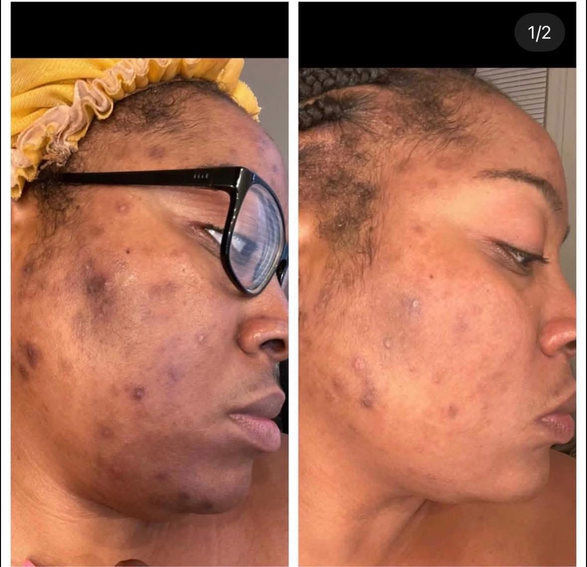 Side-by-side comparison of a black women's face with and without glasses, showing skin texture differences after using ThatGlo Turmeric Soap Bar by Blakely Bath & Co.