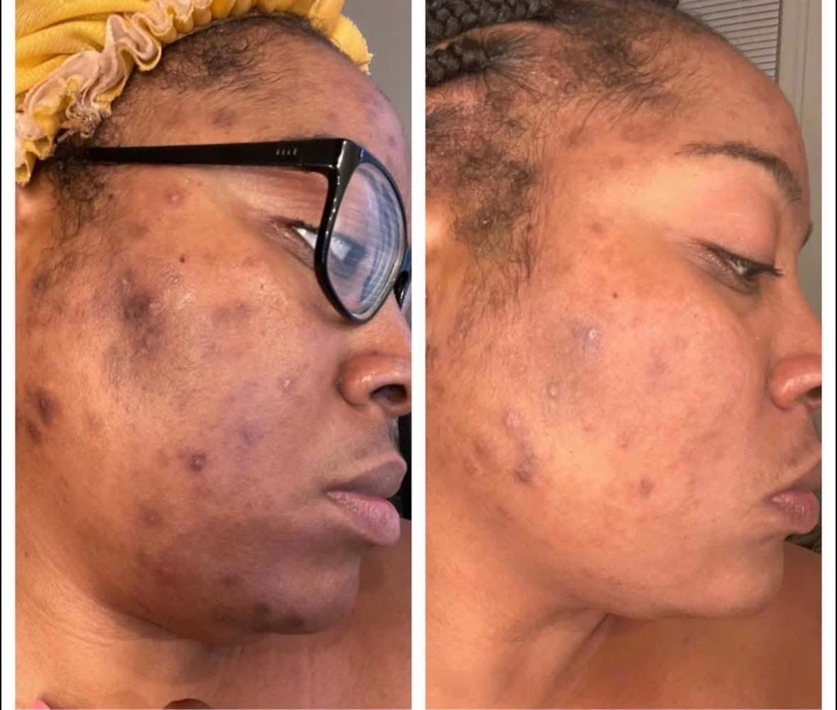 Side-by-side comparison of a black women's face with and without glasses, showing skin texture differences after using ThatGlo Turmeric Soap Bar by Blakely Bath & Co.