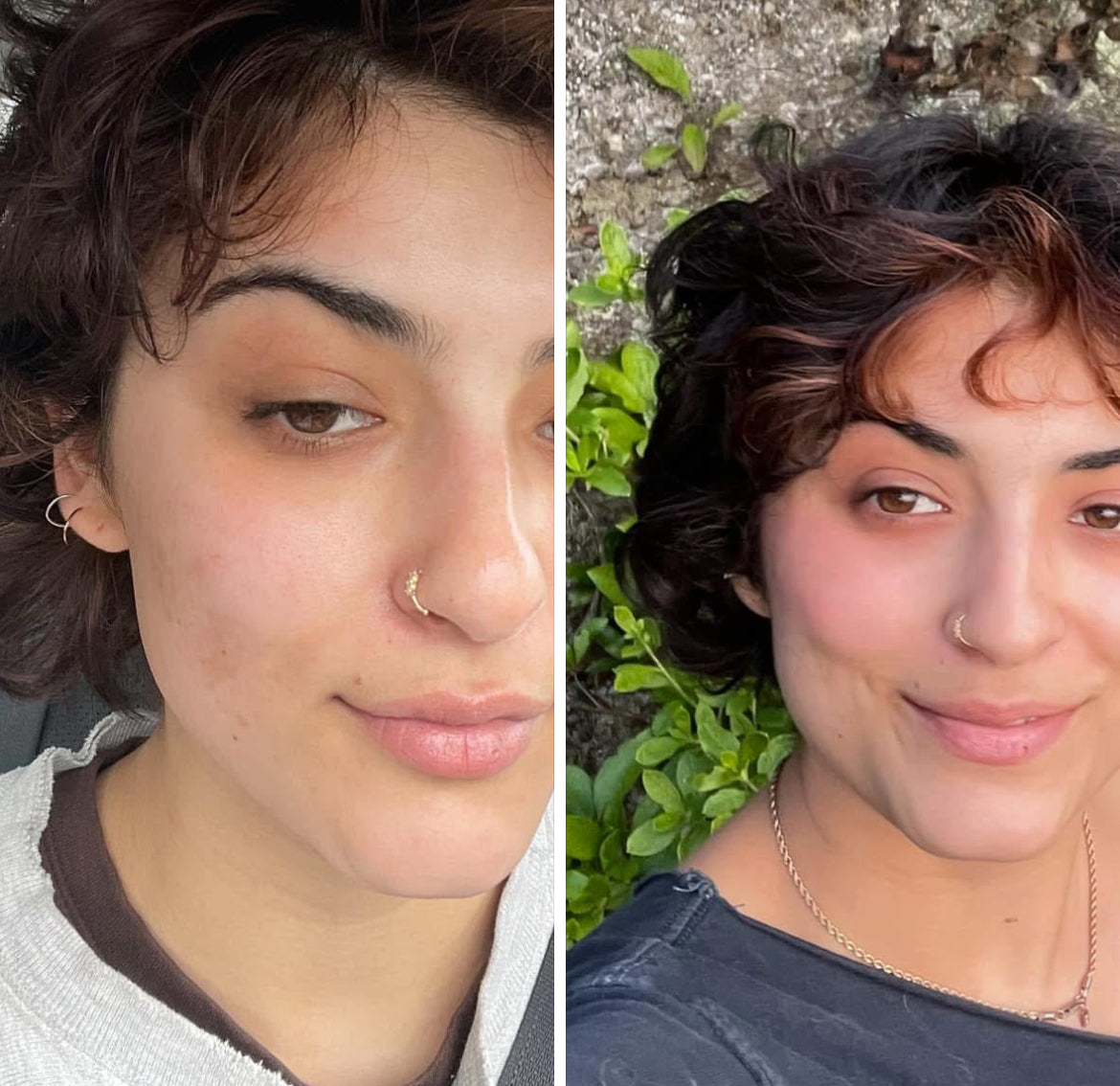 Before and after comparison showing the effectiveness of ThatGlo Turmeric Soap in reducing dark spots on Tessa Chaplin's face. The 'before' image highlights visible dark spots, while the 'after' image reveals clearer, more even-toned skin with noticeable improvement in dark spot reduction