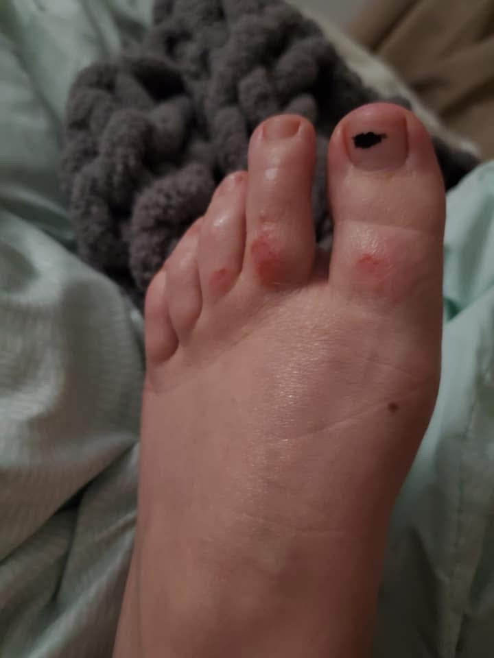 Close-up image of a foot with an eczema flare-up, showing dry, red, irritated skin before treatment. Highlights the need for soothing, natural skincare solutions.