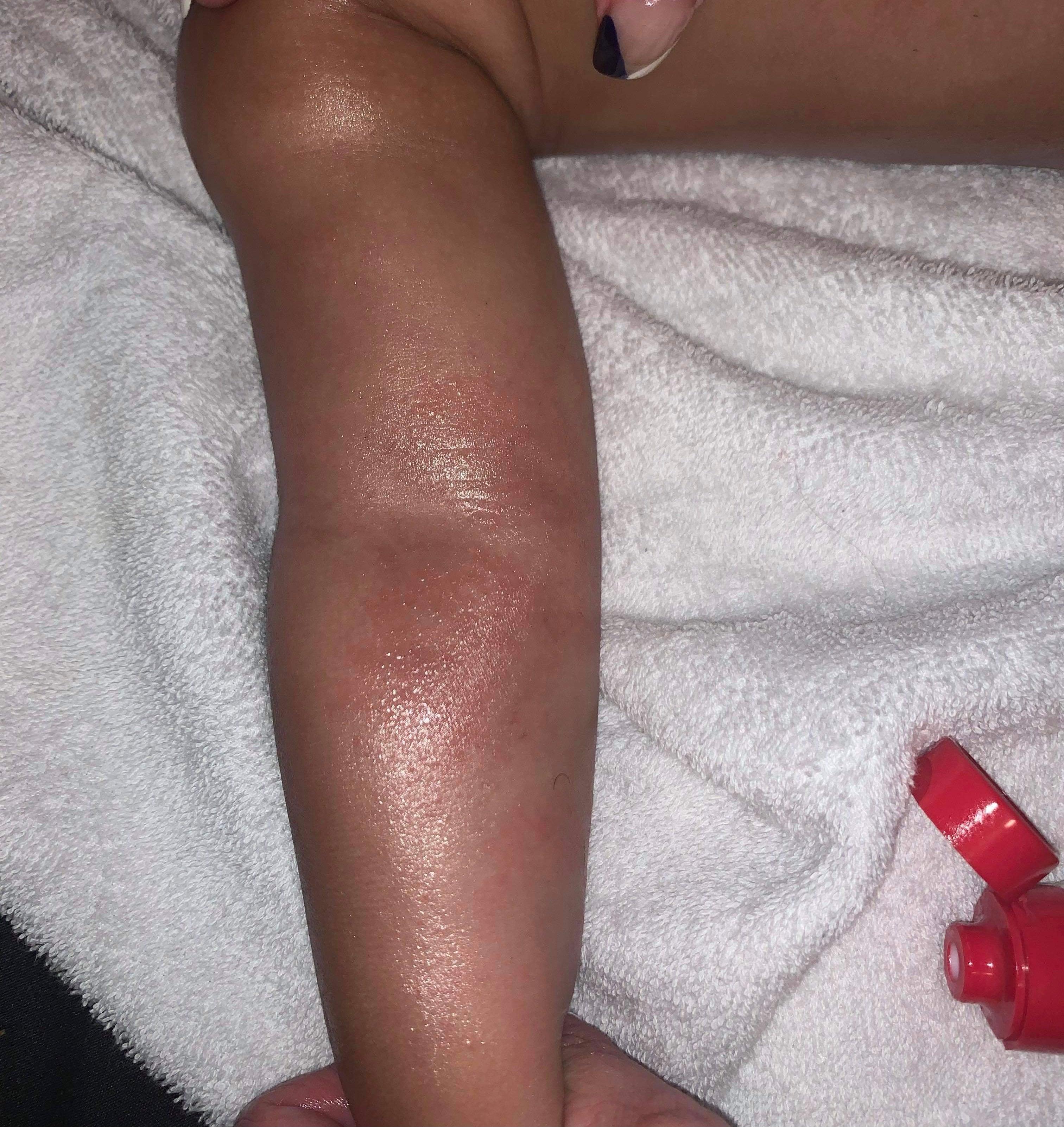 Baby with an eczema flare-up on their cheeks and arms, showing dry, red, and irritated skin in need of soothing care and hydration