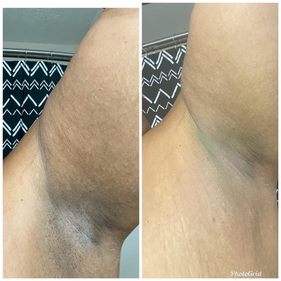 Before and after comparison of underarm skin with ThatGlo Turmeric and Kojic Acid Face and Body Scrub, showing the exfoliating results. Maria Spinner demonstrates the transformation, revealing smoother and brighter underarm skin after using the scrub