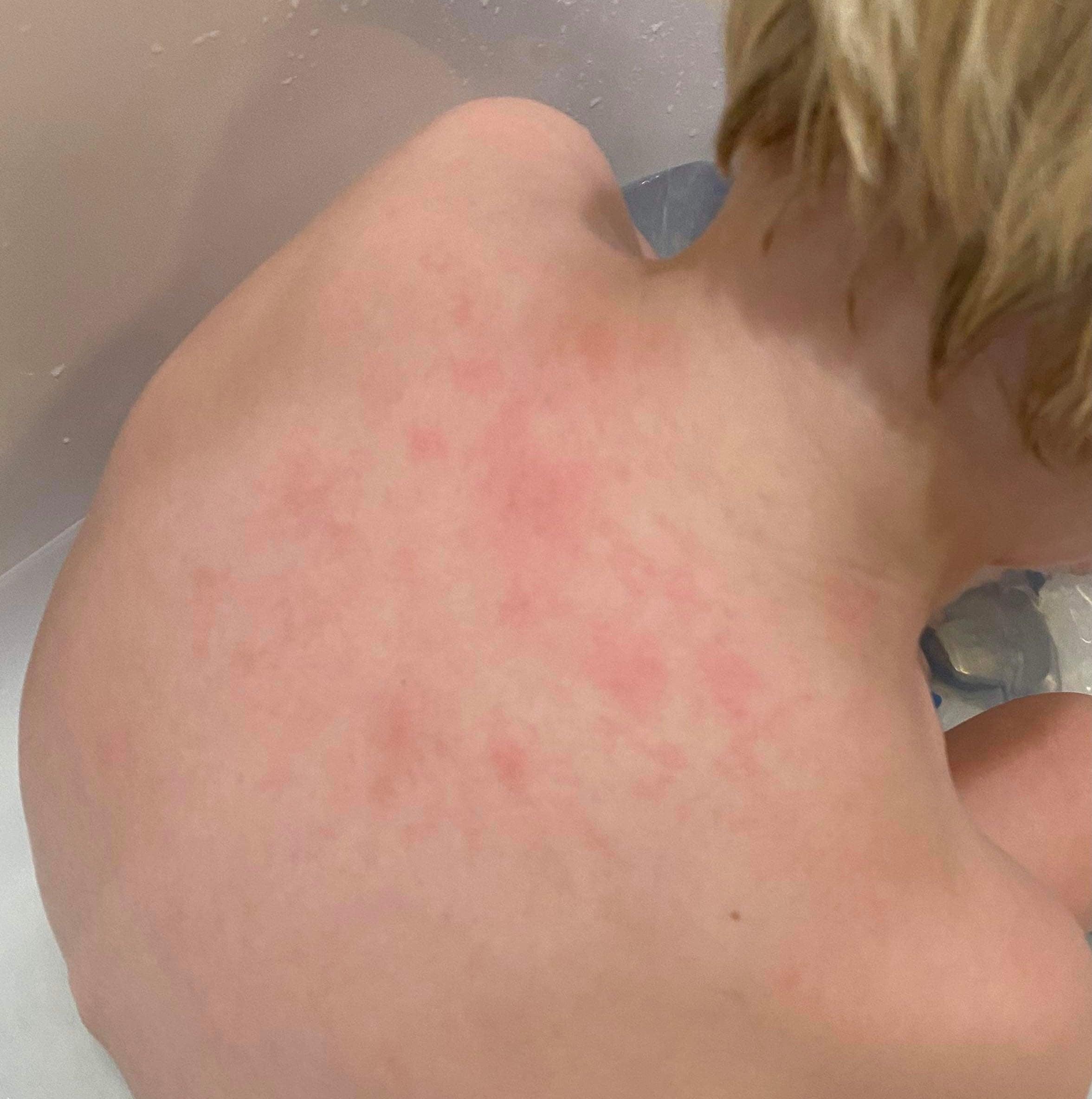 Child with an eczema breakout on their back before using the Blakely Bath & Co Dry Skin & Eczema Relief Kit, showing dry, irritated, and inflamed skin in need of soothing car